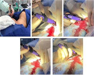 Percutaneous closure of subclavian iatrogenic injuries after central venous catheterization: a Latin American experience